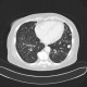 Chondrohamartoma of lung, ground-glass: CT - Computed tomography