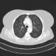 Chondrohamartoma of lung, ground-glass: CT - Computed tomography