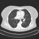 Chondrohamartoma of lung, ground-glass: CT - Computed tomography