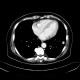 Chondrohamartoma of lung, ground-glass: CT - Computed tomography