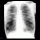 Bronchial dilators: X-ray - Plain radiograph