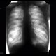 Bronchial dilators: X-ray - Plain radiograph