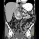 Chronic pancreatitis, calcified pancreatitis: CT - Computed tomography