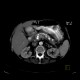 Chronic pancreatitis, calcified pancreatitis: CT - Computed tomography