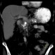 Chronic pancreatitis, calcified pancreatitis: CT - Computed tomography