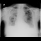 Chronic postinflammatory changes, pachypleuritis, pleural effusion, traction bronchiectasia: X-ray - Plain radiograph