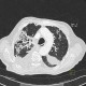 Chronic postinflammatory changes, pachypleuritis, pleural effusion, traction bronchiectasia: CT - Computed tomography