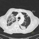 Chronic postinflammatory changes, pachypleuritis, pleural effusion, traction bronchiectasia: CT - Computed tomography