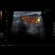 Lymphocytic thyroiditis, chronic thyreopathy: US - Ultrasound