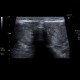 Lymphocytic thyroiditis, chronic thyreopathy: US - Ultrasound