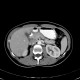 Circumaortic renal vein: CT - Computed tomography