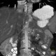Circumaortic renal vein: CT - Computed tomography