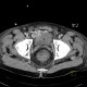 Liver cirrhosis, ascites, portal colonopathy, colopathy: CT - Computed tomography