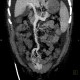 Liver cirrhosis, ascites, portal colonopathy, colopathy: CT - Computed tomography