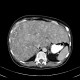 Multiple myeloma, venooclusive disease of liver, hypervascular nodules: CT - Computed tomography