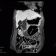 Crohn's disease, MR enterography: MRI - Magnetic Resonance Imaging