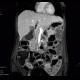 Crohn's disease, MR enterography: MRI - Magnetic Resonance Imaging