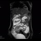 Crohn's disease, MR enterography: MRI - Magnetic Resonance Imaging