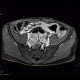 Crohn's disease, MR enterography: MRI - Magnetic Resonance Imaging