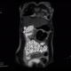 Crohn's disease, MR enterography: MRI - Magnetic Resonance Imaging