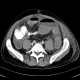 Crohn's disease of small bowel, abdominal abscess: CT - Computed tomography