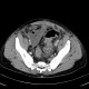 Crohn's disease of small bowel, abdominal abscess: CT - Computed tomography