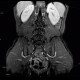 Crohn's disease of ileum, MR enterography: MRI - Magnetic Resonance Imaging