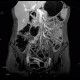 Crohn's disease of ileum, MR enterography: MRI - Magnetic Resonance Imaging