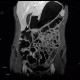 Crohn's disease of ileum, MR enterography: MRI - Magnetic Resonance Imaging