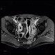 Crohn's disease of ileum, MR enterography: MRI - Magnetic Resonance Imaging