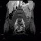 Crohn's disease of ileum, MR enterography: MRI - Magnetic Resonance Imaging