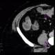 Crohn's disease, ileocecal resection, stenosis of anastomosis: CT - Computed tomography