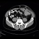 Crohn's disease, fistulising form, fistula in abdominal wall: CT - Computed tomography