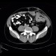 Crohn's disease, fistulising form, fistula in abdominal wall: CT - Computed tomography