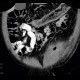 Crohn's disease, fistulising form, fistula in abdominal wall: CT - Computed tomography