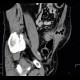 Crohn's disease, fistulising form, fistula in abdominal wall: CT - Computed tomography