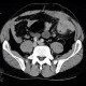 Crohn's disease, fistulising form, fistula in abdominal wall: CT - Computed tomography