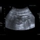 Crohn's disease, fistulising form, fistula in abdominal wall: US - Ultrasound