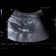 Crohn's disease, fistulising form, fistula in abdominal wall: US - Ultrasound