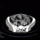 Crohn's disease of ileum, CT enterocysis, 2009: CT - Computed tomography