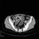 Crohn's disease of ileum, CT enterocysis, 2009: CT - Computed tomography