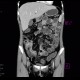 Crohn's disease of ileum, CT enterocysis, 2009: CT - Computed tomography