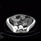 Crohn's disease of ileum, CT enterography, 2010: CT - Computed tomography