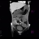 Crohn's disease of ileum, CT enterography, 2010: CT - Computed tomography