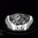 Crohn's disease of ileum, CT enterography, 2010: CT - Computed tomography