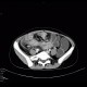 Crohn's disease of ileum, CT enterography, 2010: CT - Computed tomography