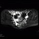 Crohn's disease of ileum, MR of pelvis, 2009: MRI - Magnetic Resonance Imaging