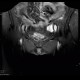 Crohn's disease of ileum, MR of pelvis, 2009: MRI - Magnetic Resonance Imaging