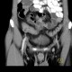 Crohn's disease of neoterminal ileum, abscess: CT - Computed tomography
