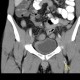 Crohn's disease of neoterminal ileum, abscess: CT - Computed tomography